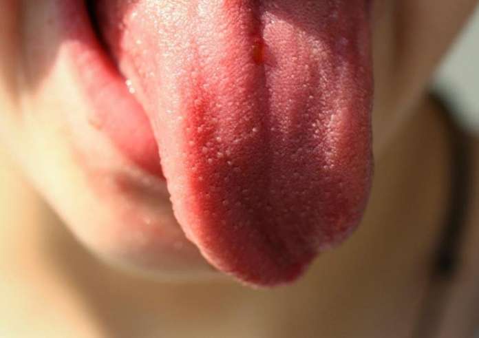Διάγνωση ασθενειών βγάζοντας τη γλώσσα! Τι σημαίνει όταν είναι κίτρινη, κόκκινη ή μωβ