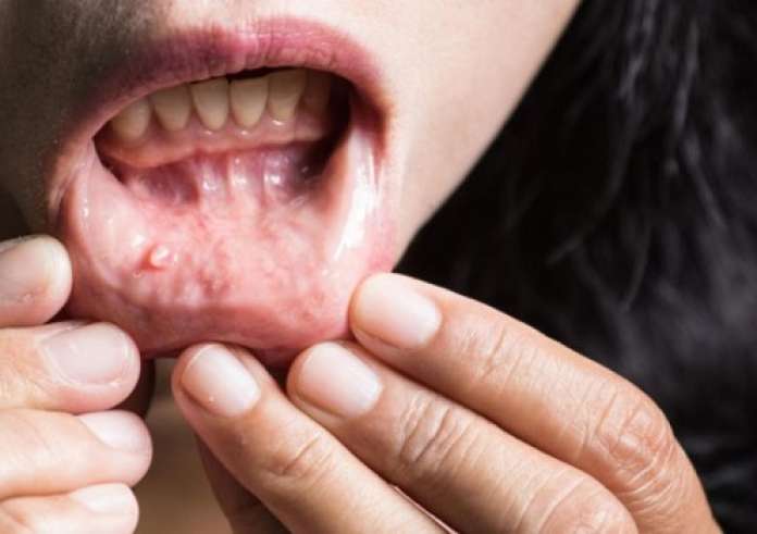 Άφθες - άφτρες στο στόμα: Αίτια, συμπτώματα και αντιμετώπιση